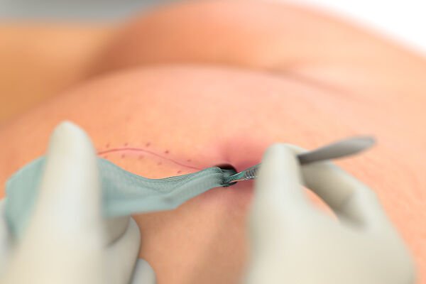 SORBACT® RIBBON GAUZE  Bakteri Bağlayıcı Şerit Yara Örtüsü   10 × 200 cm