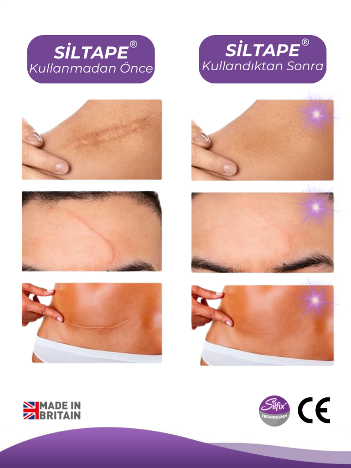 SİLTAPE Soft Silikon Bant Estetik Keloid Yanık Sezaryen Dikiş Ameliyat Izi Giderici 2cm X 3mt