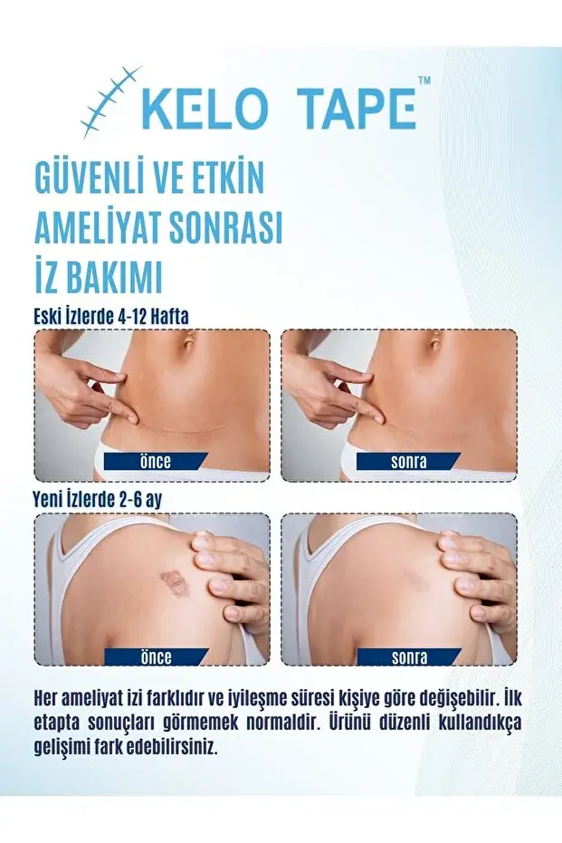 KELO TAPE Soft Silikon Bant Estetik Keloid Yanık Sezaryen Dikiş Ameliyat İzi Giderici 2 cm x 1 mt