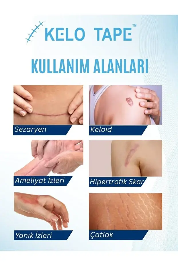 KELO TAPE Soft Silikon Bant Estetik Keloid Yanık Sezaryen Dikiş Ameliyat İzi Giderici 2 cm x 1 mt