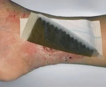 Vliwaktif Ag Gümüş İçerikli Emici Aktif Kömürlü Yara Doldurucu Yaraya Yapışmaz Örtü 10 x 10 cm